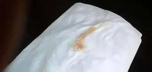 伽罗太华躺在床上分泌白色分泌物，引发网友热议，是否与新奇疗法有关？真相令人震惊！